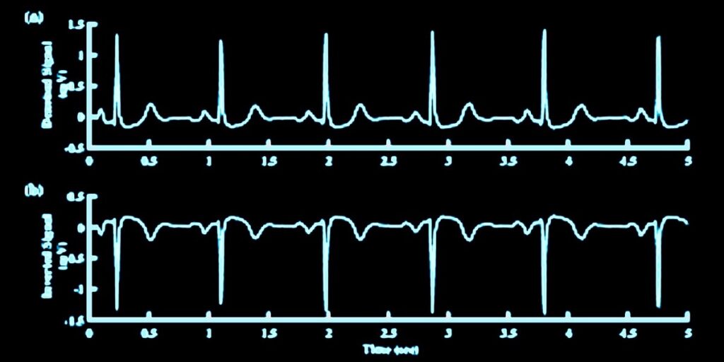 ECG/EKG reading